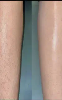 لیزر مو با تخفیفات استثنایی