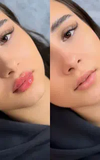 جشنواره تزریق فیلر/ژل/بوتاکس/مزوژل/پی ارپی
