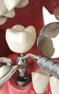 مرکز تخصصی ایمپلنت فیکسچر کره ای زیبایی دندان