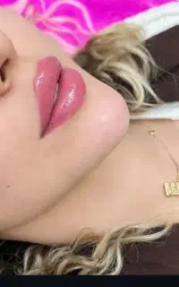 ژل لب،بوتاکس پیشانی گونه چانه زاویه فک خالبرداری