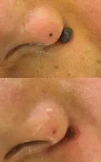 رفع لک، کک‌ومک و خال‌،ملیا،جای جوش،منگوله منافذ
