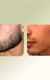 پرپشتی در ۳۰روز