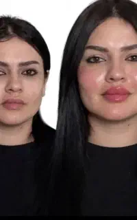 ژل،بوتاکس،فیلربادی باسن بیکینی،پی ارپی زاویه سازی