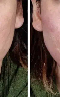 تزریق ژل و بوتاکس و مزوژل و پی آر پی