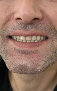ساخت دندان مصنوعی با سیستم BPS  دندانسازی تخصصی