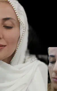 تزریق ژل و بوتاکس با متریال معتبر
