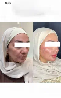 ژل-بوتاکس-فیلر-لیفت وجوانسازی توسط پزشک متخصص خانم