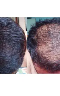 جوانسازی ناحیه کم پشت