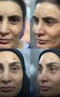 جراحی بینی / بلفاروپلاستی/ ژل بوتاکس/ هایفوتراپی