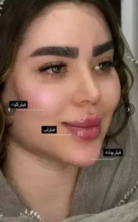 تزریق فیلربادی باسن هیپ دیپ ژل صورت،بیکینی بوتاکس