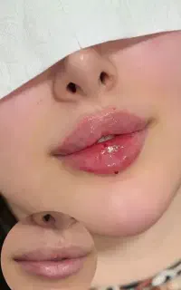 اف ژل و بوتاکس
