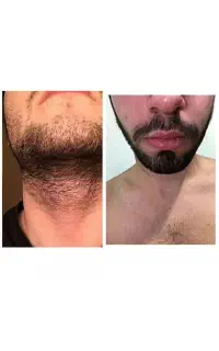 پرپشتی ریش وسبیل تضمینی