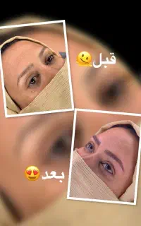 فیبروز ابرو/فیشال/مزوتراپی