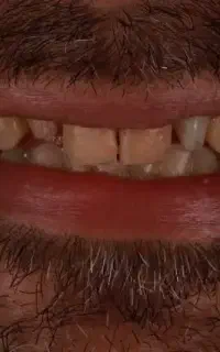 جشنواره تخفیفی دندانسازی