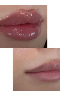 تزریق فیلر یا ژل لب در منزل