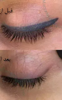 ریموو تتو ابرو و چشم، میکروبلید(فیبروز)، شیدینگ لب