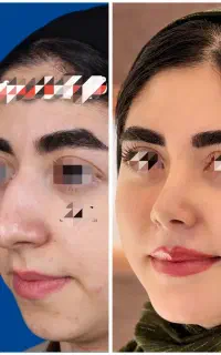 جراحی زیبایی بینی/ارومیه/ دکتر غنی‌زاده