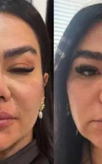 رفع خط غم و افتادگی در یک جلسه