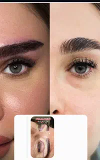 بلفارو توسط پزشک (۸۹۰۰) کاشت ابرو ۱۴ غبغب ۸تومن