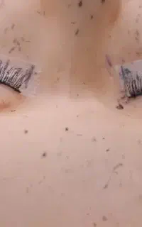 کاشت مژه