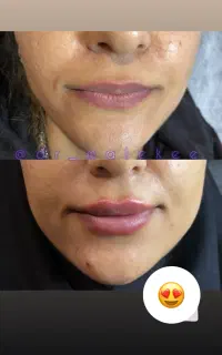 تزریق فیلر و بوتاکس