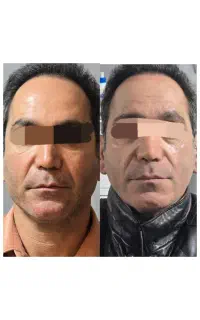 مدل تزریق فیلر و بوتاکس در کرج نیاز داریم