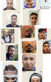 کاشت مو کاشت ریش و کاشت ابرو ومزو وپی آر پی