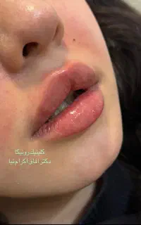 جشنواره آفر ویژه بوتاکس و فیلر