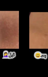 درمان قطعی لکه های پوستی