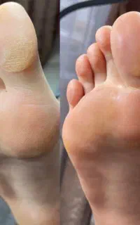 پدیکور پا و پاکسازی پوست