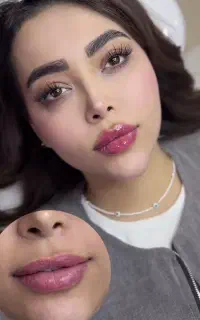 تزریق ژل بادی فیلر سینه باسن بیکینی هیپ دیپ