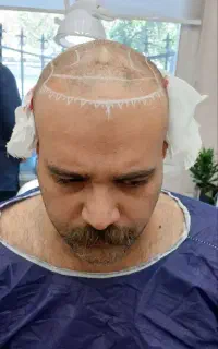بلفاروپلاستی،کاشت مو وابرو،پی آرپی،اسکالپ،عمل غبغب