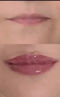 بوتاکس، فیلر، خالبرداری، لاغری‌، جوانسازی