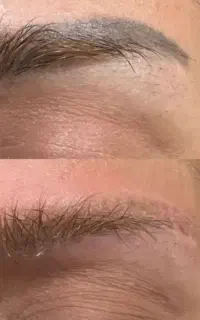 ریموو تک جلسه ای به صورت حرفهای+میکرو شیدینگ بنمژه
