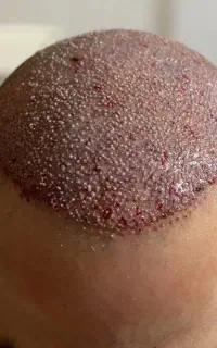 کلینیک تخصصی کاشت مو و ابرو