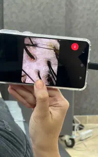 پاکسازی کف سر و درمان ریزش مو