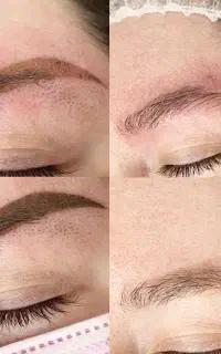 اولین و مجهزترین مرکز ریموو تک جلسه ای