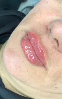 تزریق فیلر بوتاکس