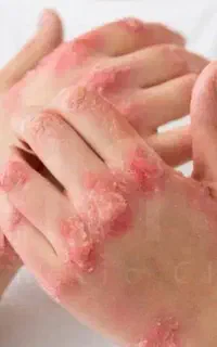 پسوریازیس فقط یک خطر نیست