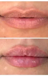 تزریق ژل و بوتاکس