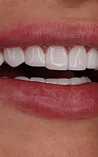 خدمات دندانپزشکی ترمیم/روکش/کامپوزیت (اقساطی)