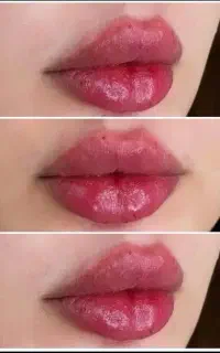 بوتاکس ۷۰۰ با شارژ رایگان و فیلر اودری 550