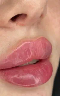 تخفیف ویژه بوتاکس، فیلر، ژل لب، prp توسط پزشک