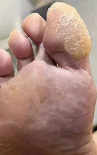 تخفیف پدیکور و کف سابی پا رفع ترک و پینه