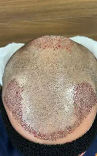 کاشت مو با متد جدید و پر تراکم طبیعی