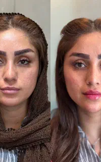 تزریق چربی به صورت به روش نانو‌فت فقط ۷/۵