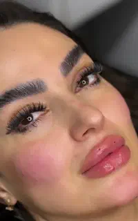 تزریق ژل و بوتاکس و مزو پوست و مو