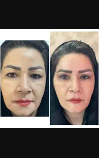 بلفاروپلاستی فقط۱۰میلیون