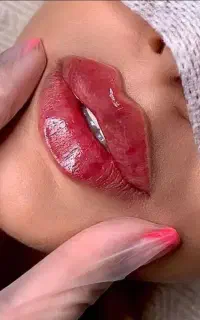 پزشک ژل مزو بوتاکس لب گونه زاویه فیلر prp آنزیم
