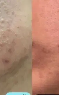 بمب ضد جوش